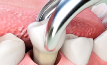 Confi Dental Tooth Extractions service