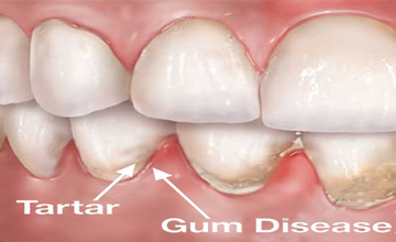 Confi Dental Periodontal (Gum) Disease service