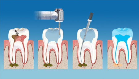 Confi Dental Endodontics  Therapy service